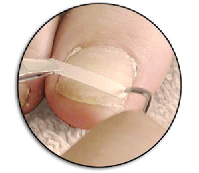 LCN Ingrown Toenail Brace, Size 18